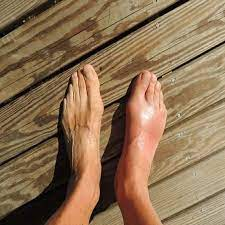 Gout – Ouch! What Do you know About it?